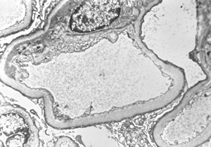 M,20y. | IgA nephropathy (Berger disease) M,20y. | IgA nephropathy (Berger disease)